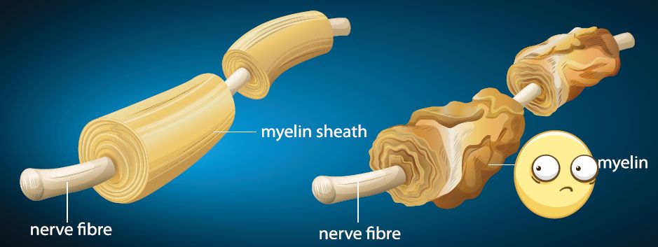 Миелин заболел, шванновская клеточка грустит&hellip;