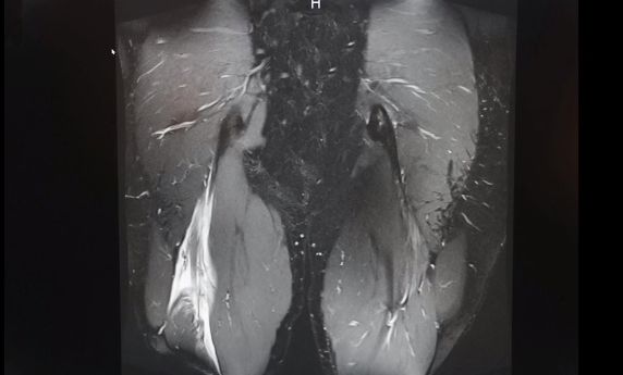 Снимок МРТ с травмой Кавилла | Изображение: https://www.instagram.com/tv/CNsUQ7Ghx-I